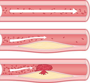 Gesunde Gefäße sind rosa